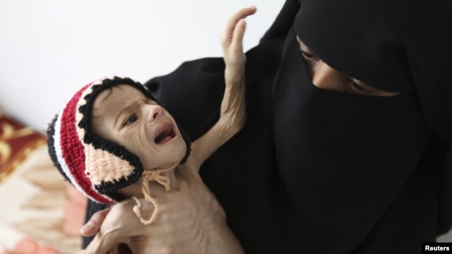 A woman holds her malnourished child at a feeding center at al-Sabyeen hospital in Yemen's capital, Sanaa, June 20, 2012.
