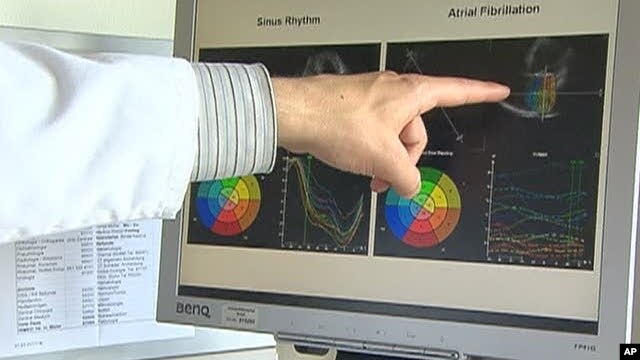Sustained Irregular Heartbeat Raises Mortality Risk for Middle Aged Women