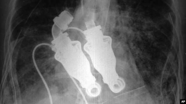 An X-ray shows a continuous-flow artificial heart