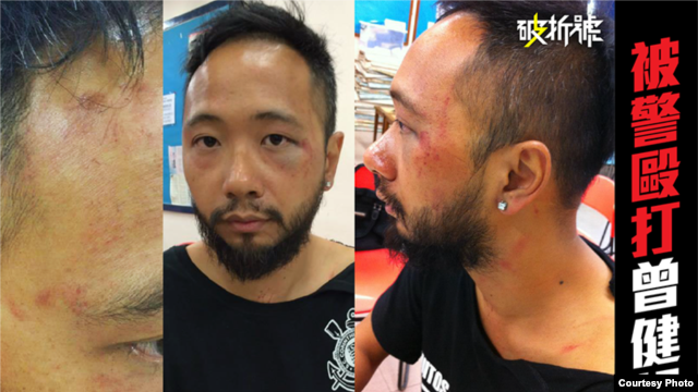 Hình ảnh anh Tsang thân thể bị bầm tím tại sở cảnh sát.