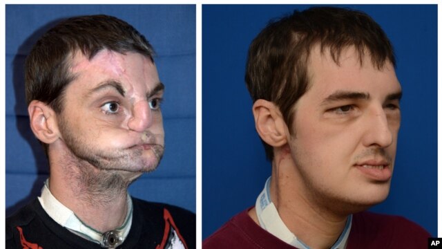 Richard Lee Noms sufrió un accidente hace 15 años y ahora luce un nuevo rostro.