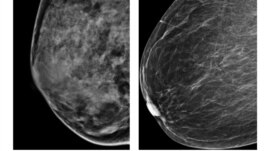 Esta radiografía del American College of Radiology muestra un pecho extremamente denso (izquierda) y otro menos denso. Un estudio ha descubierto cuatro tipos de cáncer de mama por lo que los tratamientos deben ser diferentes.