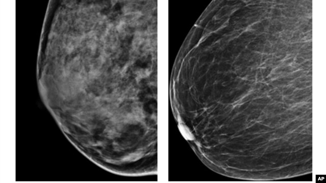Esta radiografía del American College of Radiology muestra un pecho extremamente denso (izquierda) y otro menos denso. Un estudio ha descubierto cuatro tipos de cáncer de mama por lo que los tratamientos deben ser diferentes.