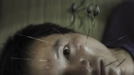 A patient suffering from facial paralysis undergoes acupuncture treatment at a traditional Chinese medical hospital in Jiaxing, Zhejiang province, July 11, 2012.