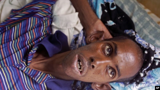 A malnourished refugee from Somalia at a field hospital of the International Rescue Committee, IRC, in Dadaab, Kenya, Wednesday, Aug. 3, 2011.
