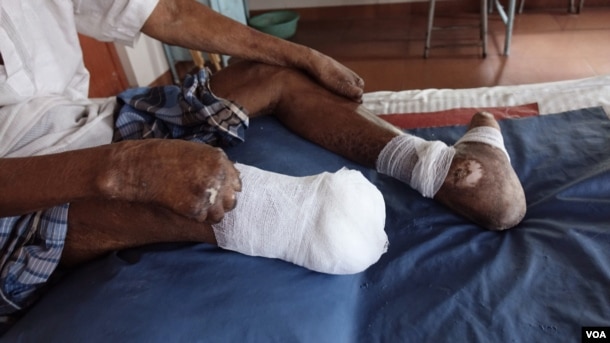 An amputated leg, claw toes and claw hands of leprosy patient Gopal Bag are seen at the Leprosy Mission Trust India hospital, Kolkata, Sept. 20 2016. (M. Hussain/VOA)