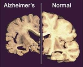 Não của bệnh nhân bị Alzheimer (trái) so với não của người không mắc Alzheimer