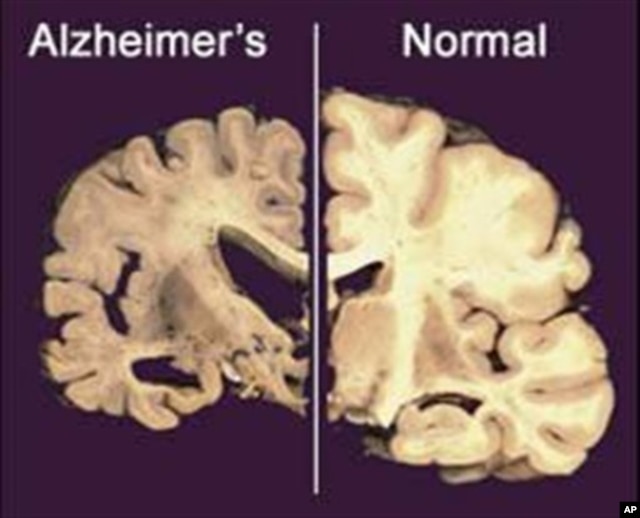 Não của bệnh nhân bị Alzheimer (trái) so với não của người không mắc Alzheimer