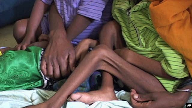 Malnourished children in Ethiopia