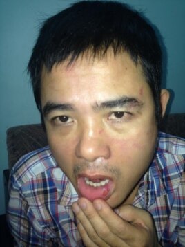 Những vết thương trên mặt anh Lê Quốc Quyết sau khi bị mật vụ truy sát (Ảnh: Danlambao)