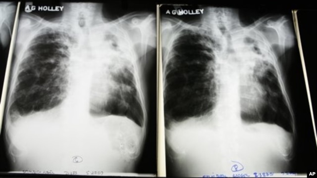 X-rays from a tuberculosis patient at A. G. Holley Hospital in Lantana, Florida, Dec. 2009 (file photo).