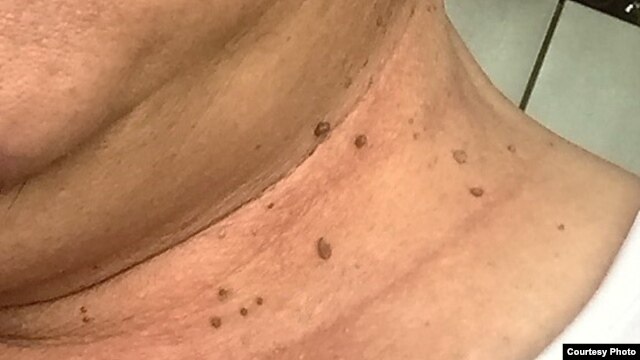 Thịt dư da (Skin tags).