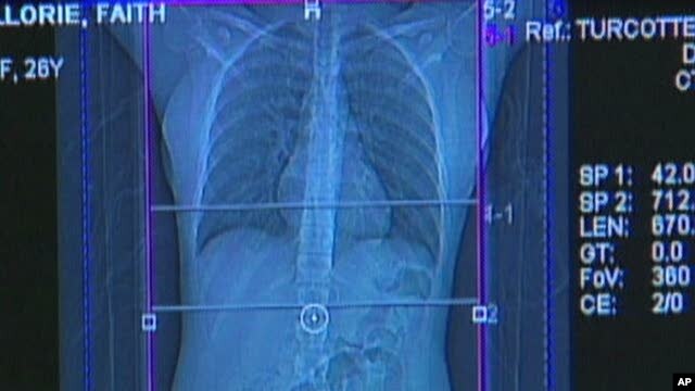 Stomach Cancer on Rise Among Certain Young White Americans