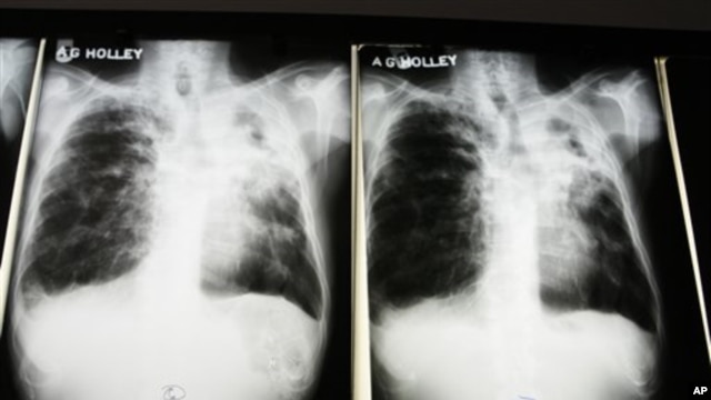 Penyakit TBC yang kebal obat meluas di seluruh dunia (foto: dok). Badan Pangan dan Obat-obatan AS telah menyetujui obat baru untuk melawan TBC ini.
