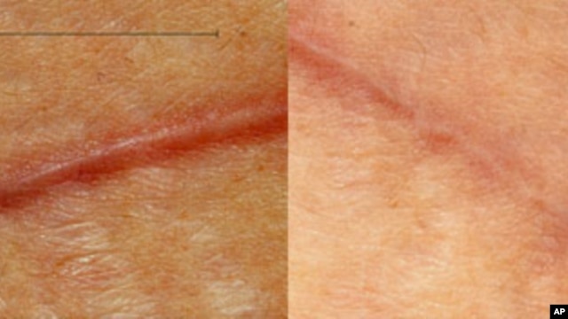 Volunteer patient who had abdominal surgery, with the left side showing the incision closed normally and the right side showing the incision closed with the new scar-reducing bandage