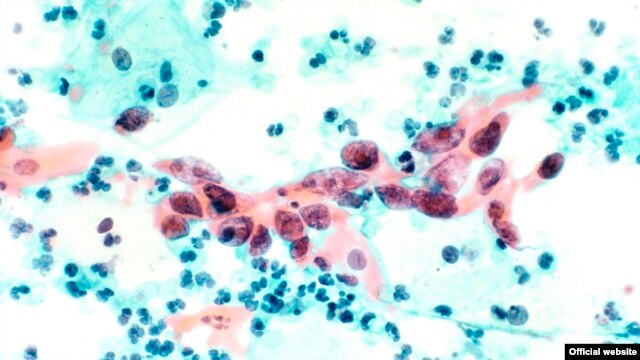 Cervical Cancer