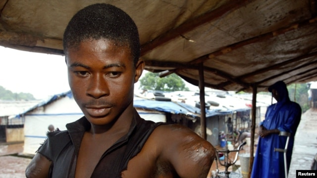 An 18-year-old man with amputated hands looks on at a camp for amputees in Freetown, July 21, 2003.