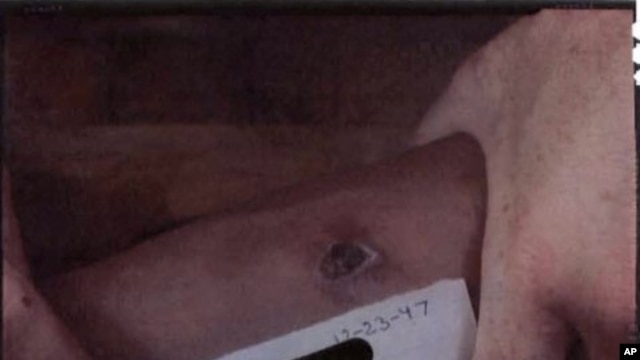 A person holds a sign with the date December 23, 1947 next to the wound of a person who had been infected with a venereal disease in the late 1940s in an unknown location in Guatemala, in this undated picture released online in March 2011 by The National 