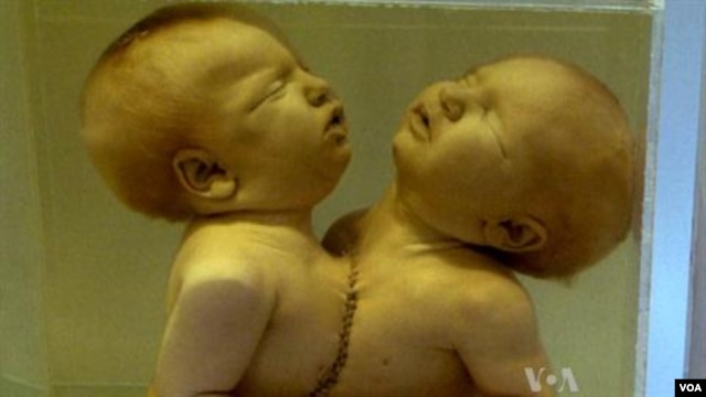 Remains of conjoined twins on exhibit at the National Museum of Health and Medicine