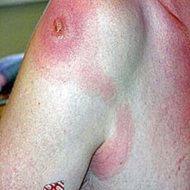 Lesion on shoulder, which is symptomatic of Sleeping Sickness