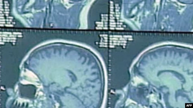 Bệnh Alzheimer và các con số