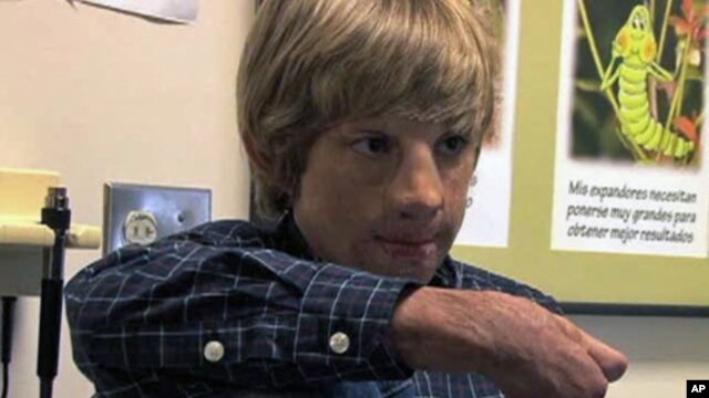 12-year-old Marius Dasianu, a burn victim from Romania has found hope, and a new family, in the US