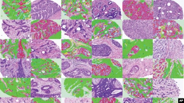 This image shows breast cancer images adjacent to matching images that have been automatically labeled by image processing software.