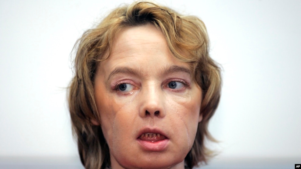 FILE - Isabelle Dinoire, the woman who received the world's first partial face transplant with a new nose, chin and mouth, in an operation on Nov. 27, 2005.