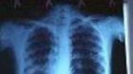 Tens of Millions of TB Patients Cured