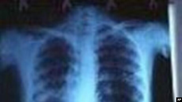 Tens of Millions of TB Patients Cured