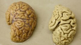 Một bán cầu não khỏe mạnh (trái) và một bán cầu não của một người bị bệnh Alzheimer.