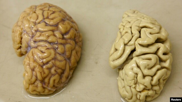 Một bán cầu não khỏe mạnh (trái) và một bán cầu não của một người bị bệnh Alzheimer.