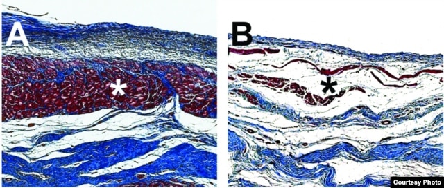 Microscopic images of pig hearts damaged by heart attack show the growth of new heart muscle tissue (shown in red, Figure A) after treatment with an injectable hydrogel compared to a heart left untreated (Figure B, right). Image Credit: Karen Christman, UC San Diego Jacobs School of Engineering.