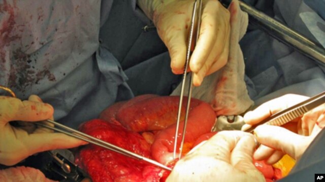 The surgeons sew a piece of small intestine from the transplanted pancreas to Tiffany Buchta's own intestine during her double transplant surgery.