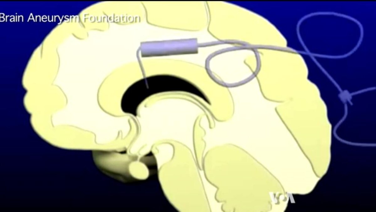 Aneurysm: Definition and Significance Aneurysm: Definition and Significance