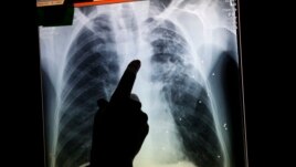 24 Marsi, Dita Botërore e Tuberkuzolit