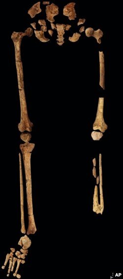 The 31,000 year-old-skeleton discovered in a cave in East Kalimantan, Borneo Indonesia, is photographed at Griffith University in Brisbane, Australia, Sept. 1, 2022. The remains, which have been dated to 31,000 years old, mark the oldest evidence for amputation yet discovered. And the prehistoric “surgery” could show that humans were making medical advances much earlier than previously thought, according to the study published Wednesday, Sept. 7, 2022 in the journal Nature. (Tim Maloney/Griffith University via AP)