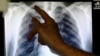 FILE — Clinical lead doctor Al Story points to an X-ray showing a pair of lungs infected with tuberculosis in London, Jan. 27, 2014. 