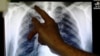 Seorang dokter menunjukkan bagiaan baru-baru yang terinfeksi tuberculosis, London, 17 June 2014. (Foto: Luke MacGregor/Reuters)