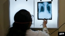 (FILE) A doctor checks the chest X-ray of a patient diagnosed with tuberculosis at the Médecins Sans Frontières clinic in Mumbai.
