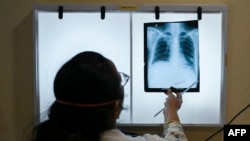 FILE - In this picture taken on March 22, 2022, a doctor checks the chest X-ray of a patient diagnosed with tuberculosis at the Médecins Sans Frontières clinic in Mumbai.