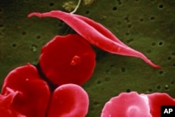 This electron microscope image provided by the National Institutes of Health in 2016 shows a blood cell altered by sickle cell disease, top.