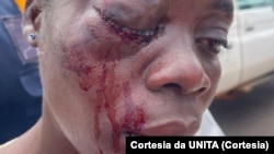 Militante da UNITA ferida no ataque contra caravana de deputados, Lunga, Cuando Cubango, Angola, 12 abril 2024