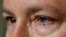 Phil Durst's left eye bore the brunt of a 2017 work accident. He underwent an experimental cell procedure that returned his vision.