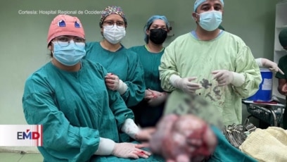 Extraen tumor gigante a embarazada en Guatemala