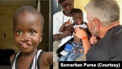 FILE- Courtesy photos showing a child, doctor, and mother before and after the operation of cleft lip surgery in Juba, South Sudan November 2024.