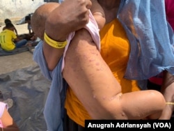 Sebagian pengungsi Rohingya terutama anak-anak, mulai jatuh sakit. Yang paling umum adalah gatal-gatal di kulit dan kepala. (VOA/Anugrah Adriansyah)