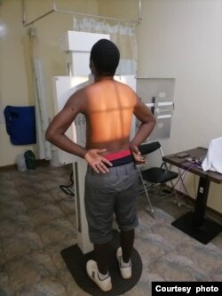 Obert Dube in hospital soon after he was beaten up by police in Victoria Falls. (Photo/Credit: Obert Dube)