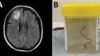 Un gusano de 8 centímetros ha sido encontrado vivo en el cerebro de una mujer en Australia.