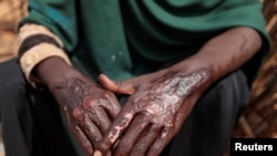FILE — A Sudanese woman, pictured on Aug. 5, 2023 at her makeshift shelter in Adre, Chad, shows burn scars on her hands that she sustained in April 2023, after Rapid Support Forces and Arab militia forces torched the camp where she was living in El Geneina.